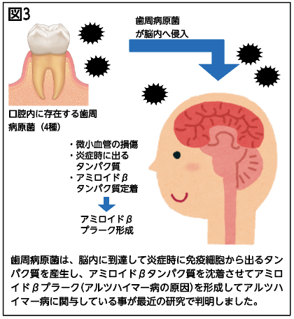 図3歯周病原菌が脳内へ侵入口腔内に存在する歯周病原菌(4種)・微小血管の損傷・炎症時に出る　タンパク質・アミロイドβ　タンパク質定着アミロイドβプラーク形成歯周病原菌は、脳内に到達して炎症時に免疫細胞から出るタンパク質を産生し、アミロイドβタンパク質を沈着させてアミロイドβプラーク(アルツハイマー病の原因)を形成してアルツハイマー病に関与している事が最近の研究で判明しました。